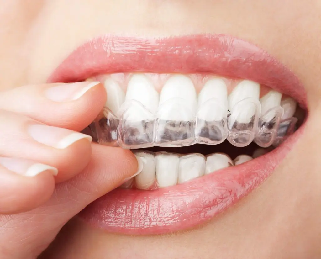 Invisalign Poznań