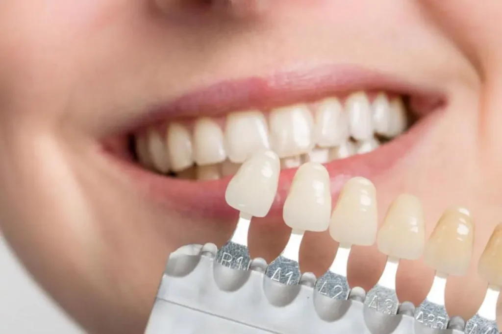 Licówki dentystyczne Poznań